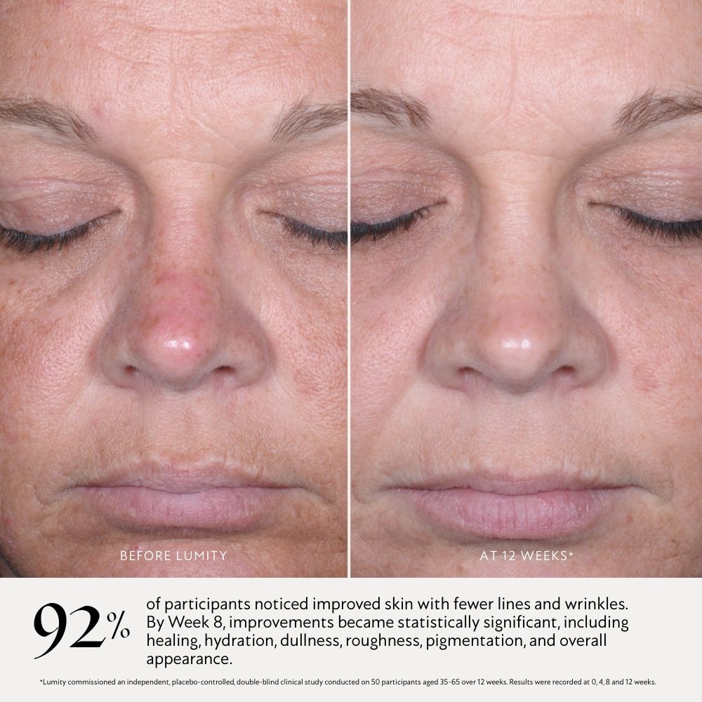 before and after picture of female clinical trial participant displaying skin tone & texture differences at day 0 and week 12 of taking Lumity